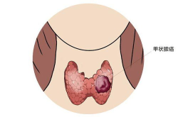 甲状腺癌能治好吗,甲状腺癌治疗进展与治愈可能性分析